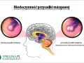 Mgła mózgowa, lęk, depresja? To może być gruczolak przysadki