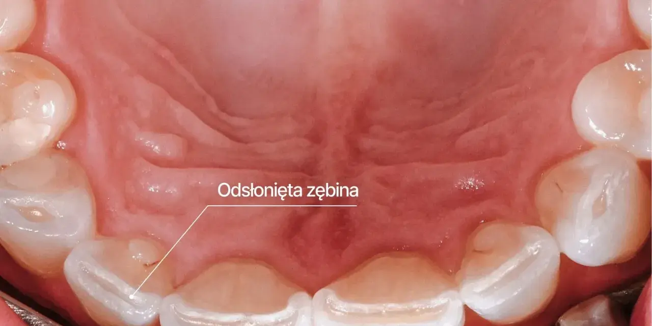 Widoczne odsłonięte zęby, objaw bruksizmu. Zęby są starte, co może prowadzić do bólu i nadwrażliwości.