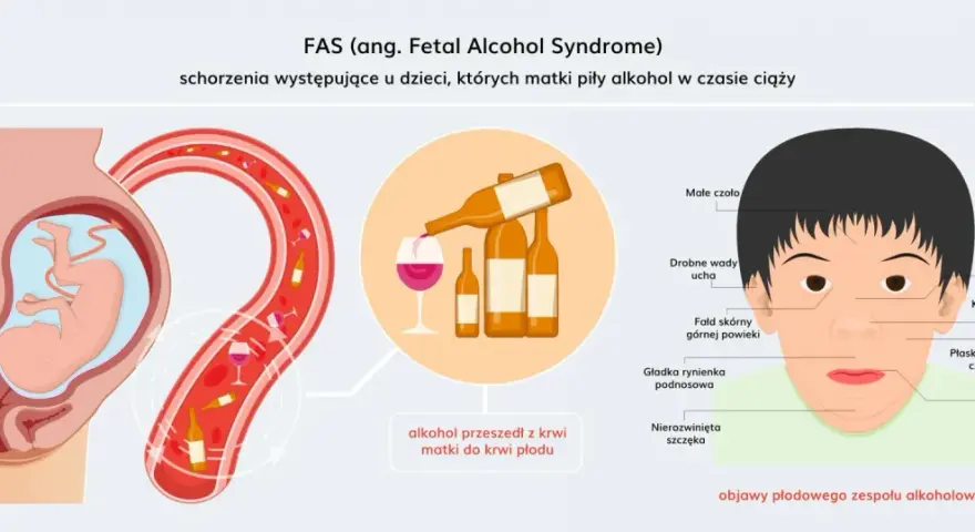 Ilustracja pokazuje płód w łonie matki, butelki alkoholu i dziecko z cechami FAS. Alkohol przechodzi z krwi matki do płodu, powodując zaburzenia.