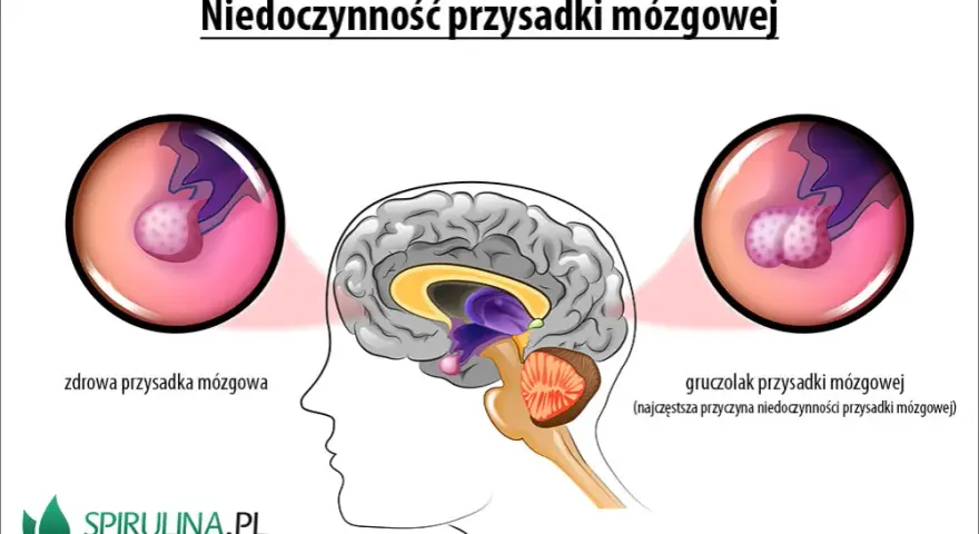 Mgła mózgowa, lęk, depresja? To może być gruczolak przysadki